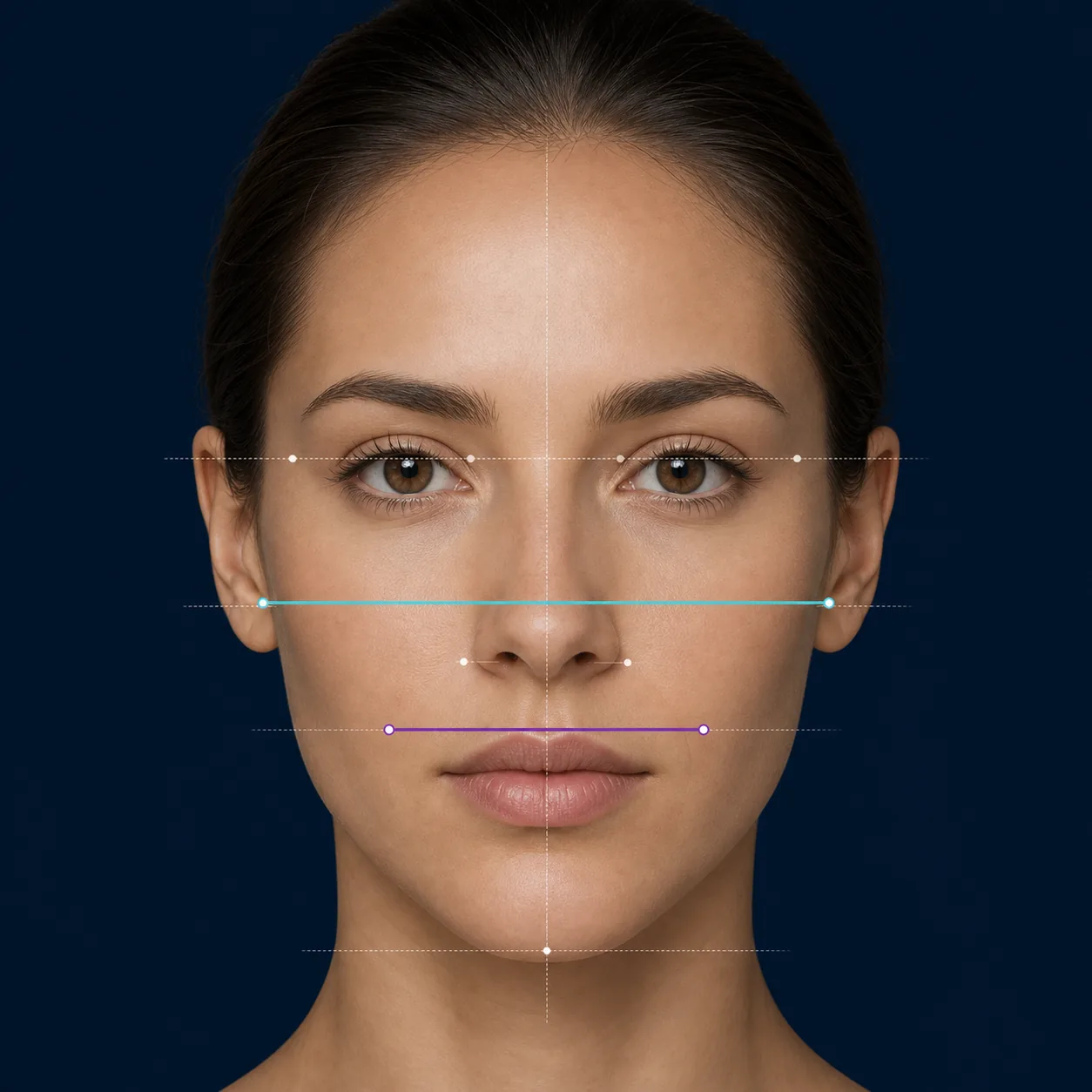 Editorial diagram showing facial landmarks used in midface measurements